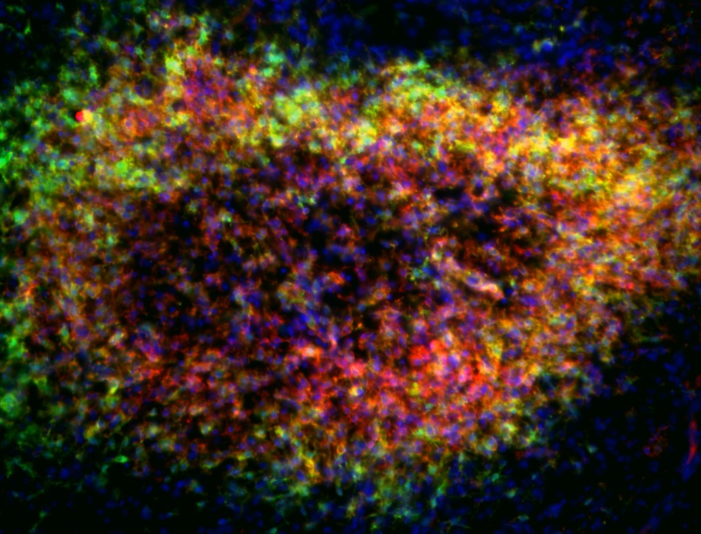 Activated (green) and phagocytic (red) microglial cells surround a lesion in the vestibular nucleus of an Ndufs4KO mice. 